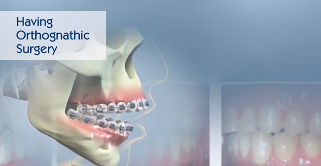 Having Orthognathic Surgery Video Thumbnail
